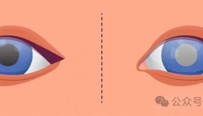 日照爱尔眼科小课堂丨经常晒太阳，会得白内障吗？